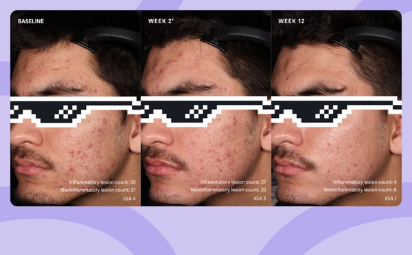 Patient 1: Male. Success. Study SGT-65-04: double-blind, randomized, vehicle-controlled safety and efficacy 12-week study of tretinoin, (0.1%) and benzoyl peroxide, (3%) vs. vehicle cream. [4] *Week 2 results were a secondary endpoint in a clinical study that primarily measured results after 12 weeks.