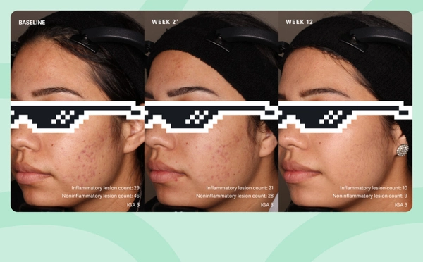 Patient 2: Female. Failure. Study SGT-65-04: double-blind, randomized, vehicle-controlled safety and efficacy 12-week study of tretinoin, (0.1%) and benzoyl peroxide, (3%) vs. vehicle cream. [4] *Week 2 results were a secondary endpoint in a clinical study that primarily measured results after 12 weeks.