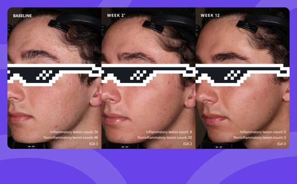 Patient 3: Male. Success. Study SGT-65-04: double-blind, randomized, vehicle-controlled safety and efficacy 12-week study of tretinoin, (0.1%) and benzoyl peroxide, (3%) vs. vehicle cream. [4] *Week 2 results were a secondary endpoint in a clinical study that primarily measured results after 12 weeks.