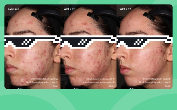 Patient 4: Female. Failure. Study SGT-65-05: double-blind, randomized, vehicle-controlled safety and efficacy 12-week study of tretinoin, (0.1%) and benzoyl peroxide, (3%) vs. vehicle cream. [4] *Week 2 results were a secondary endpoint in a clinical study that primarily measured results after 12 weeks.